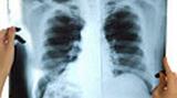 Radiografiile toracice ajută la depistarea timpurie a cancerului pulmonar