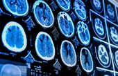 Un tratament experimental a redus la jumătate o tumoare cerebrală